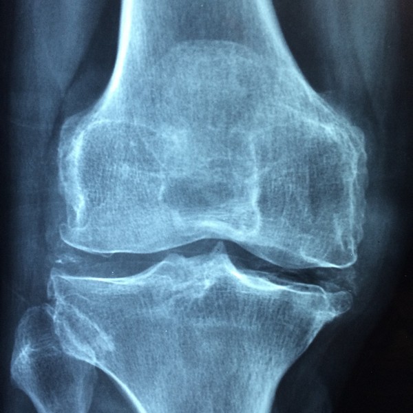 knee-1406964_1920-modified.jpg
